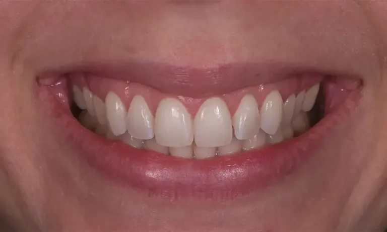After treatment: restored gum tissue covering the previously exposed roots
