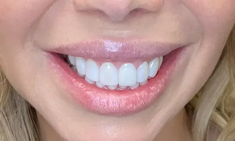 After treatment: a recontoured gum line with porcelain veneers