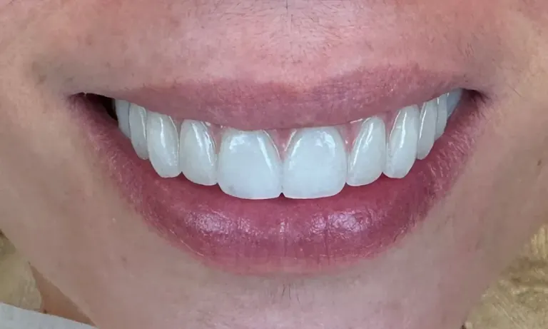 After treatment: a completed upper All-on-X zirconia restoration