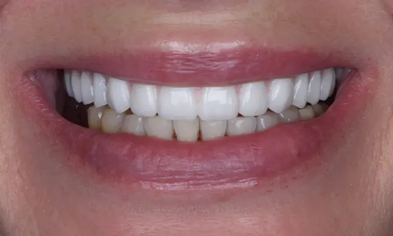 After treatment: a fixed full-arch implant restoration in the upper jaw