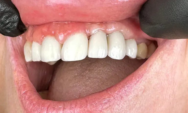 After treatment: implants restored with individual crowns on the upper left