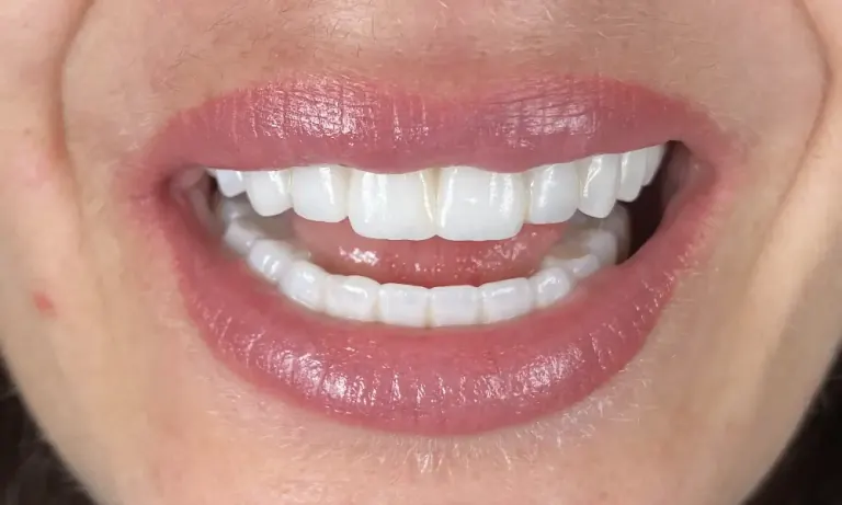 After treatment: implant-supported zirconia bridges replacing the failing teeth