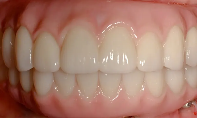 A completed full-arch restoration that reads as natural teeth