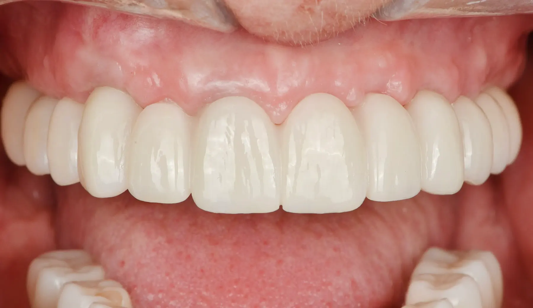 Close-up of a completed zirconia implant bridge