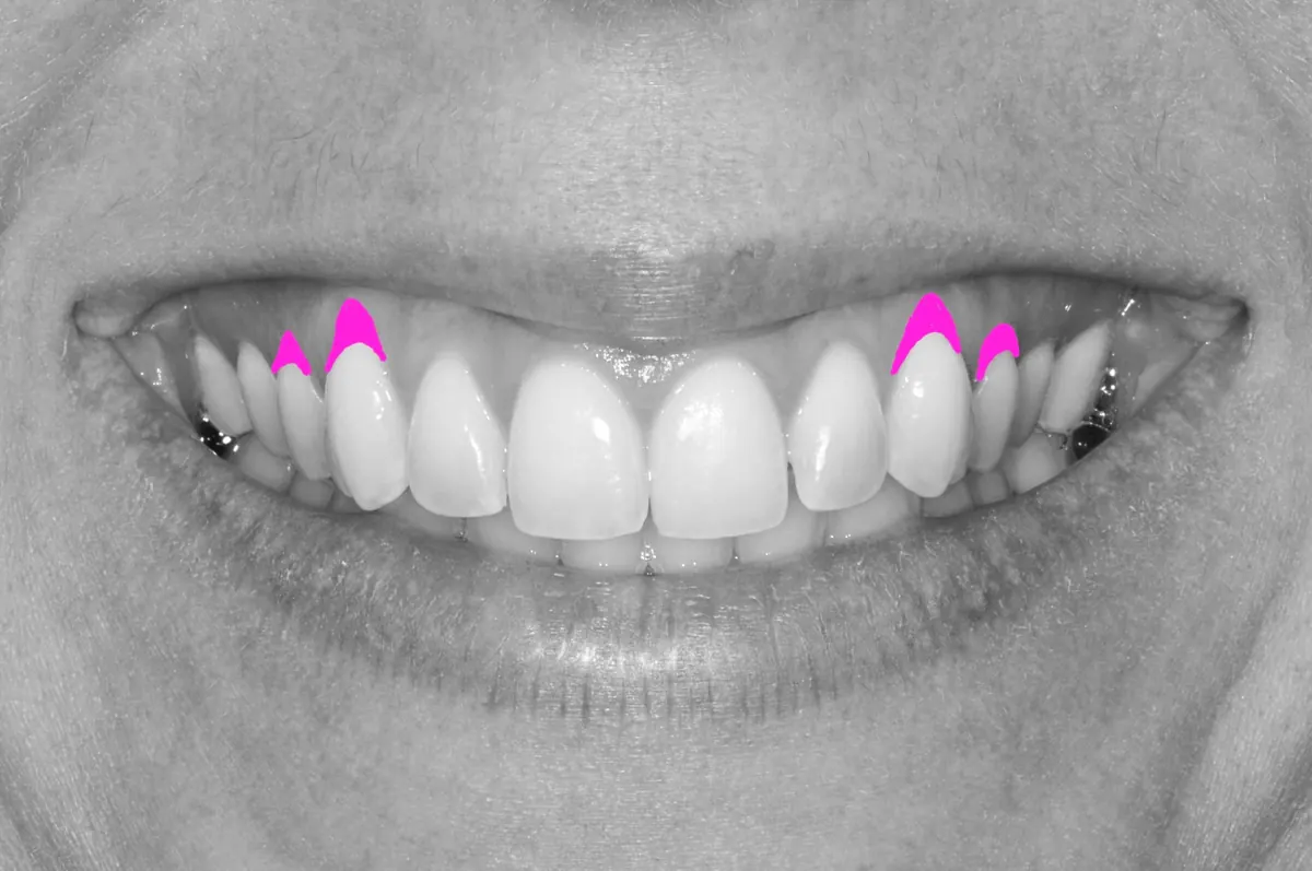 Digital smile design analysis used to plan the finished result
