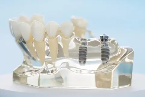 Dental implant model showing planned placement within the jaw