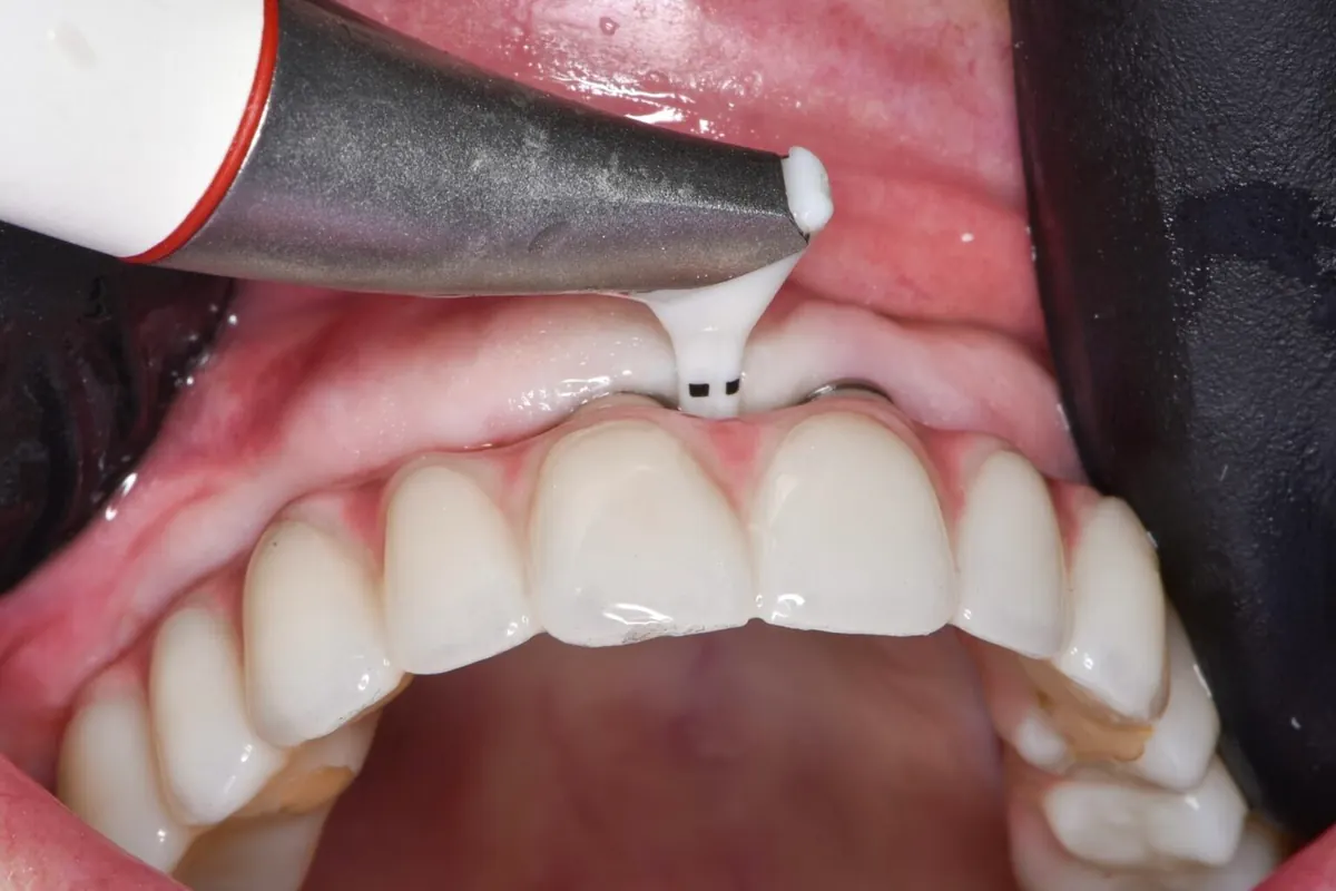 Intraoral digital scanner taking a impression at ImplantWIDE