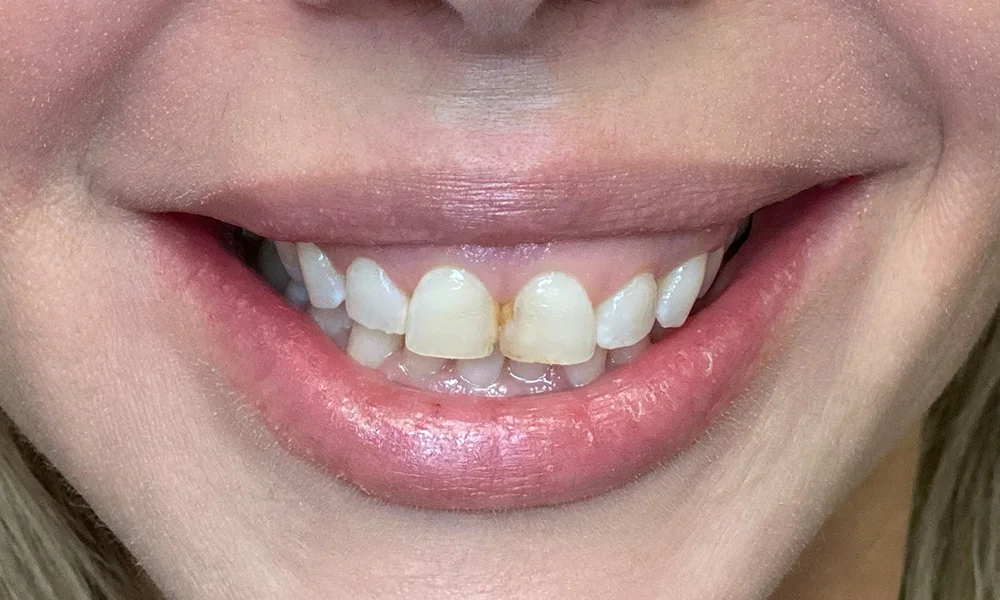 Gummy smile recontouring and porcelain veneers before