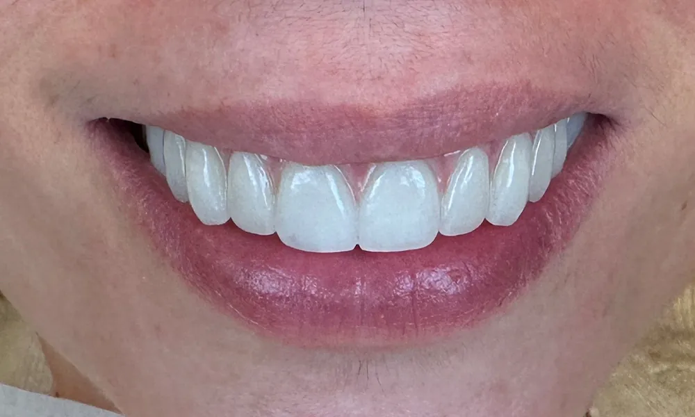 Upper All on X Zirconia digital protocol before after