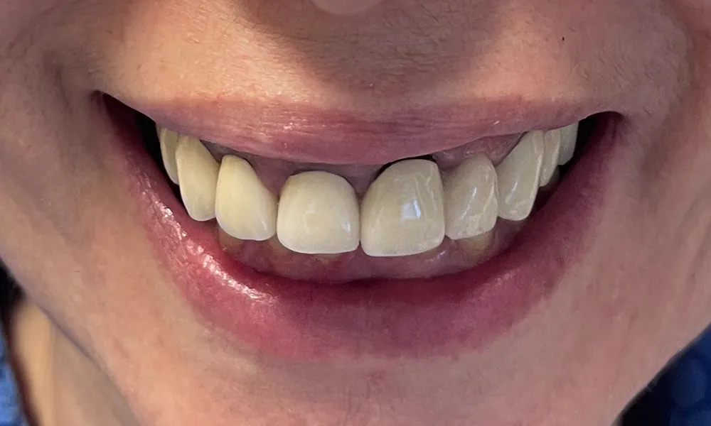 Upper All on X Zirconia digital protocol before