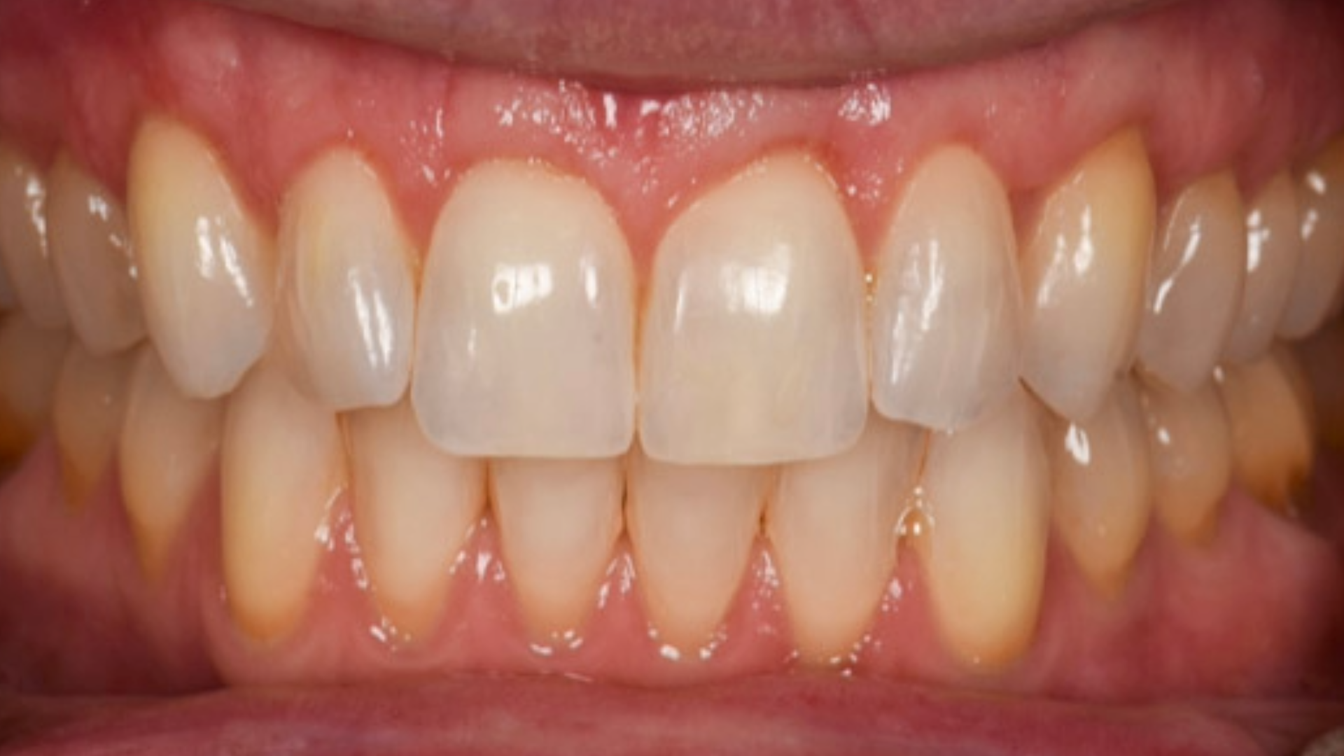 Soft Tissue Graft (CTG) 7 Untitled 3 1