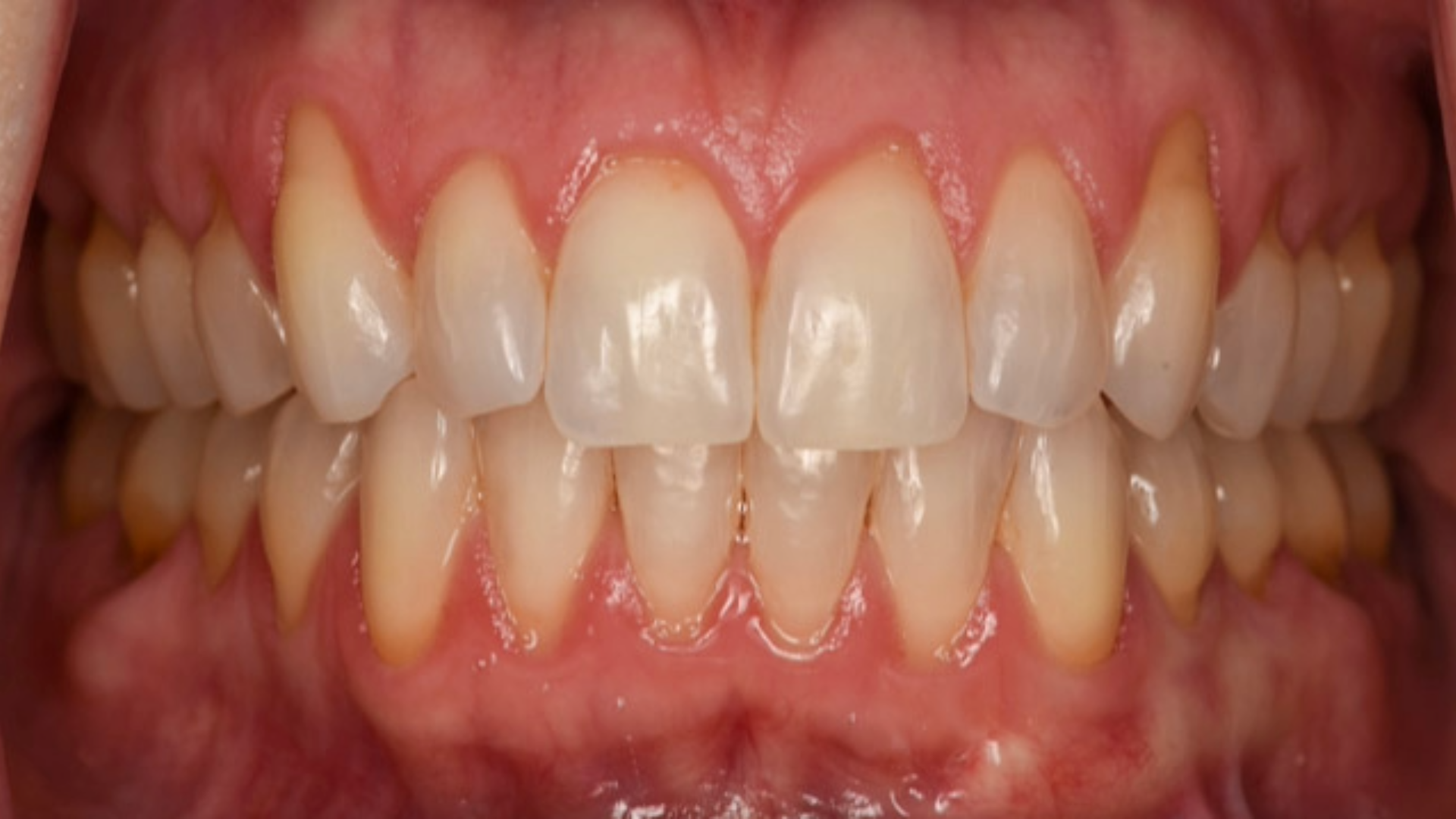 Soft Tissue Graft (CTG) 6 Untitled