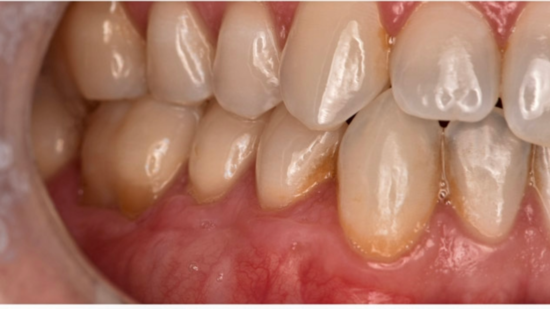 Soft Tissue Graft (CTG) 13 after 1