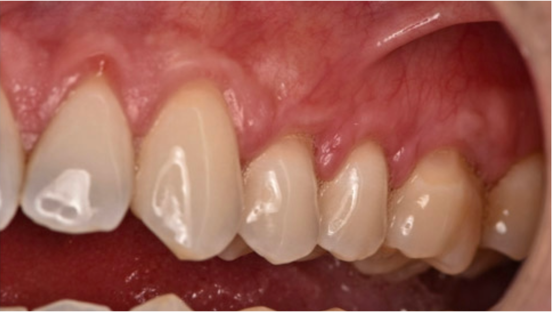 Soft Tissue Graft (CTG) 11 after