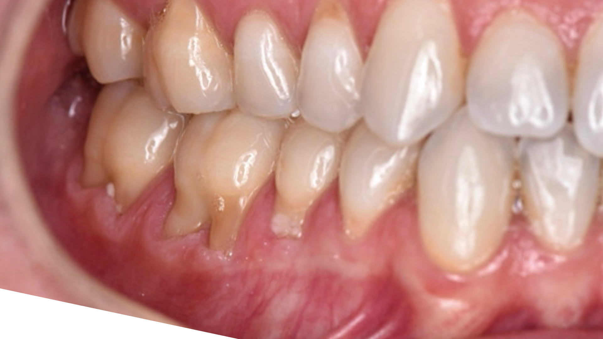 Soft Tissue Graft (CTG) 12 before 1