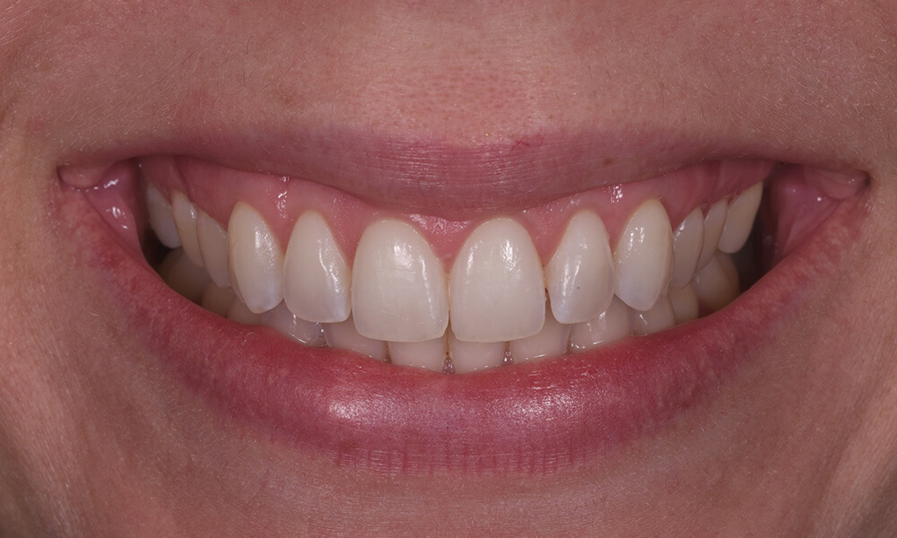ctg case 01 after