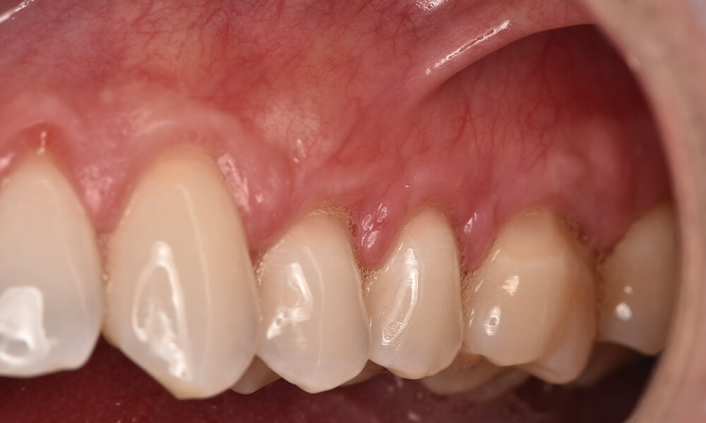 ctg case 05 after