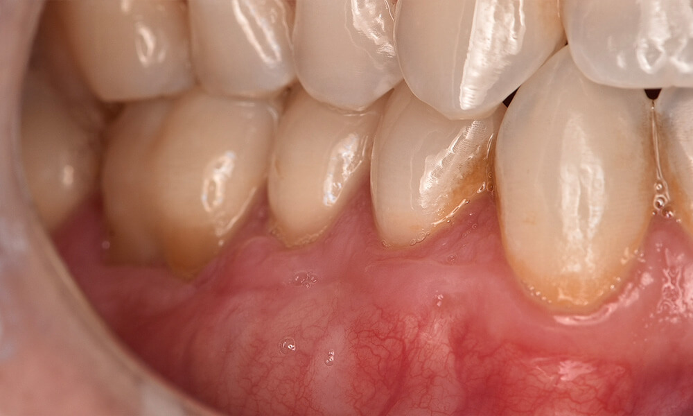 ctg case 06 after