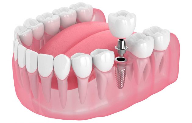 Dental-Implants