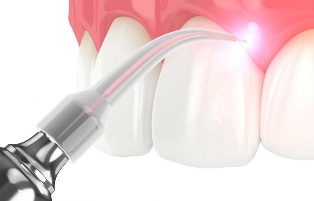 Laser-Gum-Treatment